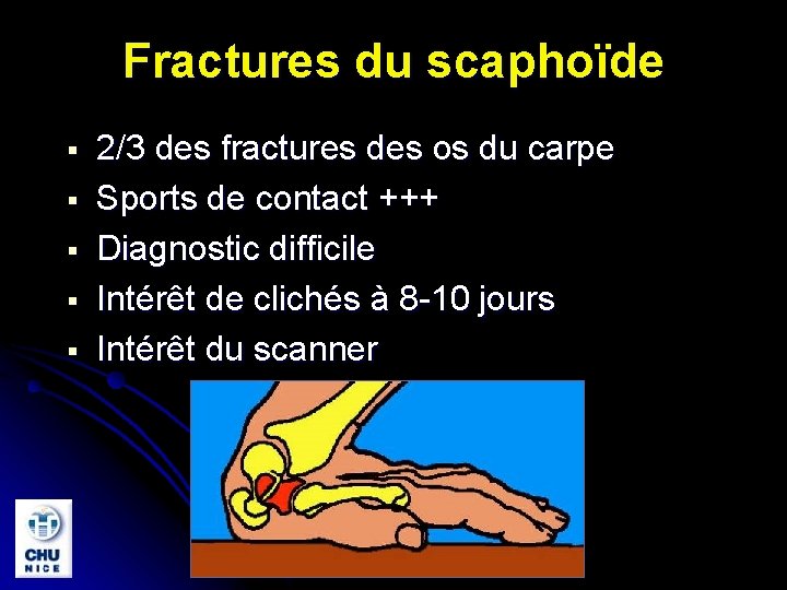 Fractures du scaphoïde § § § 2/3 des fractures des os du carpe Sports