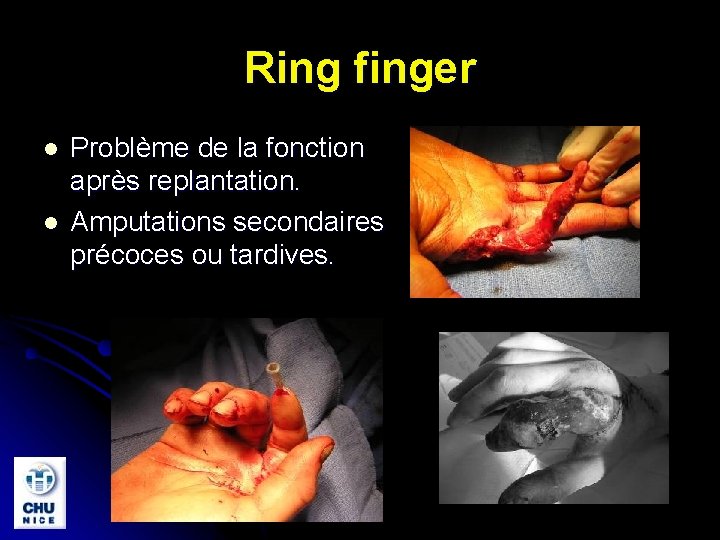 Ring finger l l Problème de la fonction après replantation. Amputations secondaires précoces ou