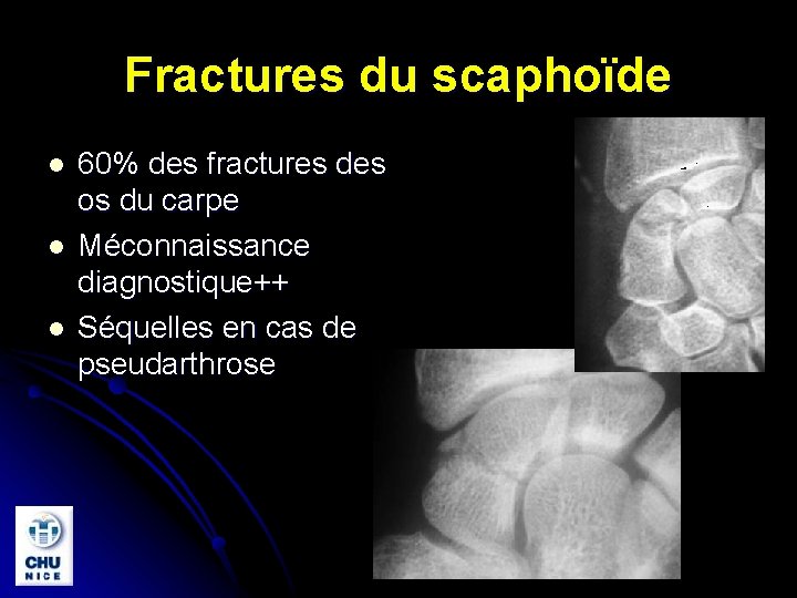 Fractures du scaphoïde l l l 60% des fractures des os du carpe Méconnaissance