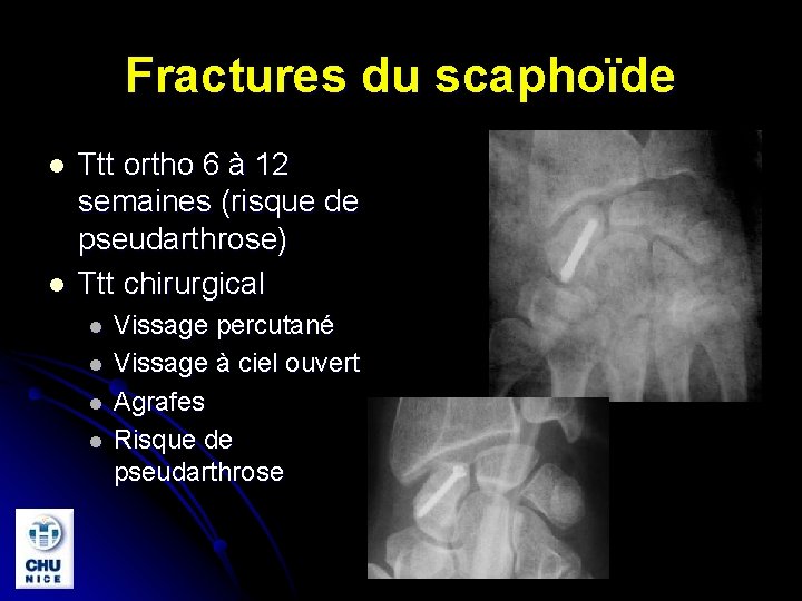 Fractures du scaphoïde l l Ttt ortho 6 à 12 semaines (risque de pseudarthrose)