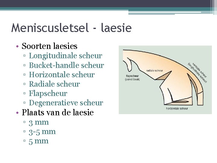 Meniscusletsel - laesie • Soorten laesies ▫ ▫ ▫ Longitudinale scheur Bucket-handle scheur Horizontale