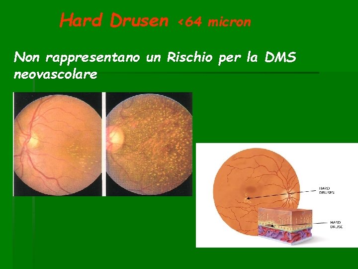 Hard Drusen <64 micron Non rappresentano un Rischio per la DMS neovascolare 