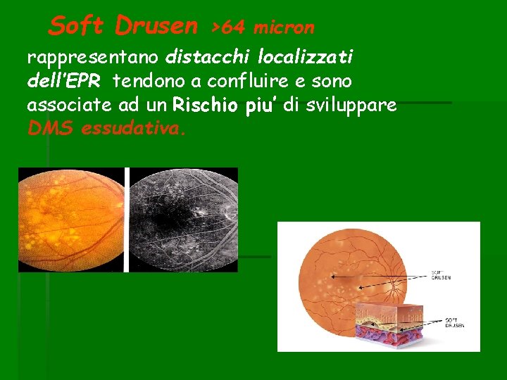 Soft Drusen >64 micron rappresentano distacchi localizzati dell’EPR tendono a confluire e sono associate
