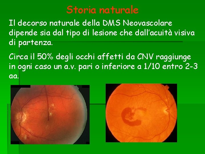 Storia naturale Il decorso naturale della DMS Neovascolare dipende sia dal tipo di lesione