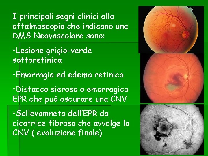 I principali segni clinici alla oftalmoscopia che indicano una DMS Neovascolare sono: • Lesione