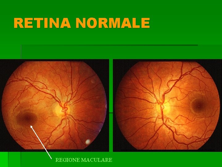 RETINA NORMALE REGIONE MACULARE 