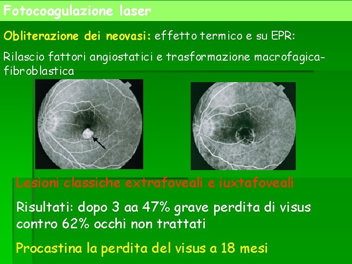 Fotocoagulazione laser Obliterazione dei neovasi: effetto termico e su EPR: Rilascio fattori angiostatici e