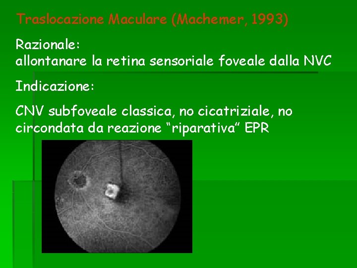 Traslocazione Maculare (Machemer, 1993) Razionale: allontanare la retina sensoriale foveale dalla NVC Indicazione: CNV