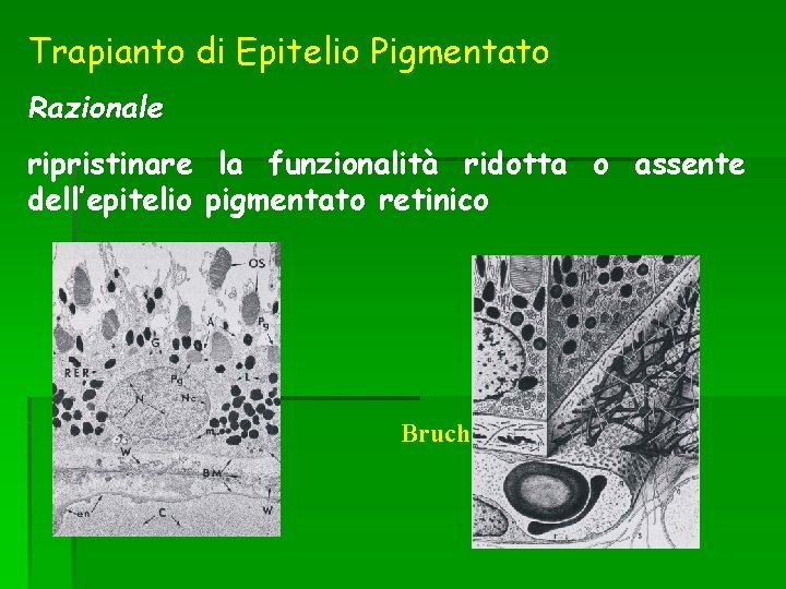 Trapianto di Epitelio Pigmentato Razionale ripristinare la funzionalità ridotta o assente dell’epitelio pigmentato retinico