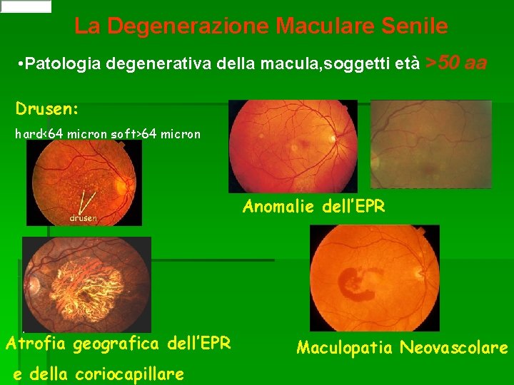 La Degenerazione Maculare Senile • Patologia degenerativa della macula, soggetti età >50 aa Drusen: