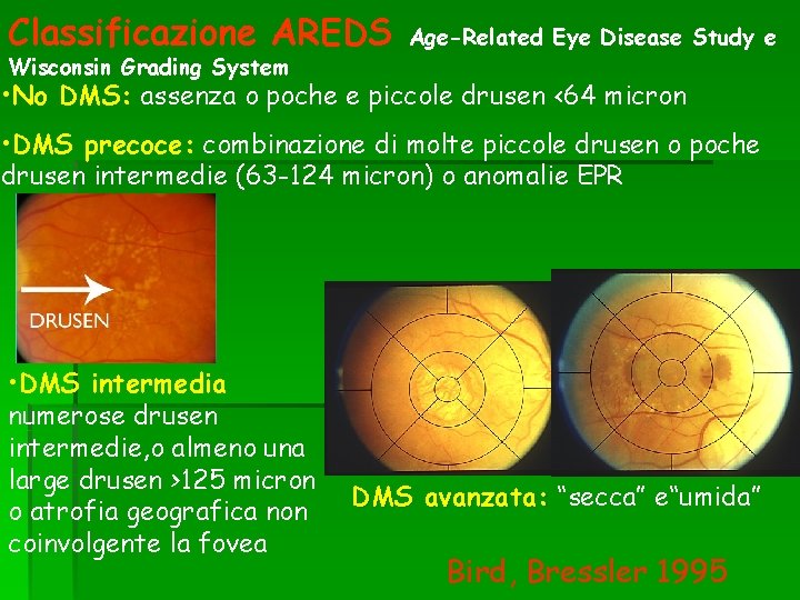 Classificazione AREDS Wisconsin Grading System Age-Related Eye Disease Study e • No DMS: assenza