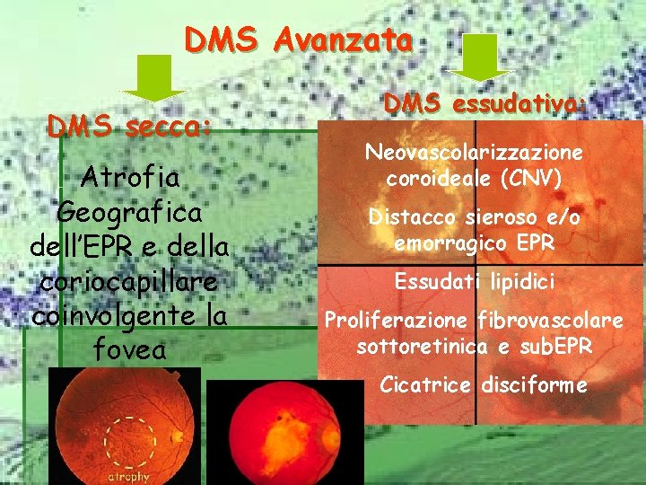 DMS Avanzata DMS secca: Atrofia Geografica dell’EPR e della coriocapillare coinvolgente la fovea DMS