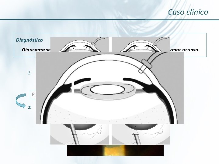 Caso clínico Diagnóstico Glaucoma secundario de ángulo cerrado por mala dirección del humor acuoso