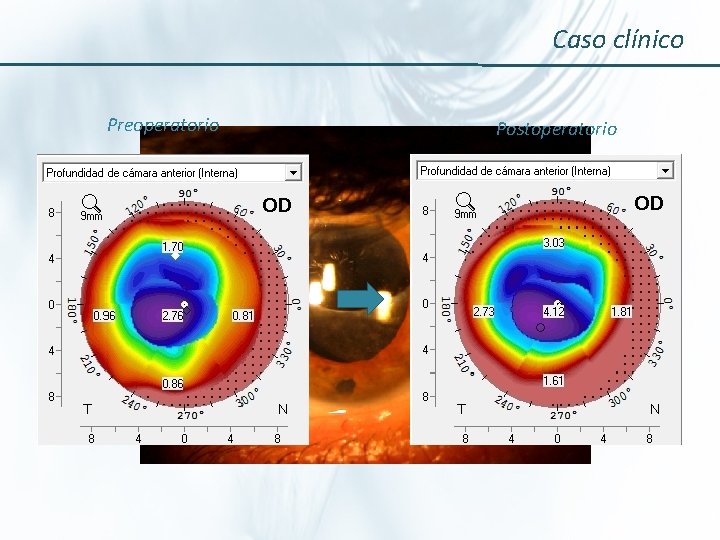 Caso clínico Preoperatorio Postoperatorio 