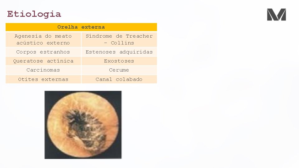 Etiologia Orelha externa Agenesia do meato acústico externo Síndrome de Treacher – Collins Corpos