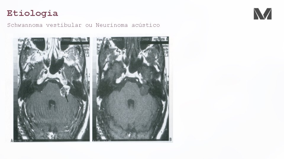 Etiologia Schwannoma vestibular ou Neurinoma acústico 