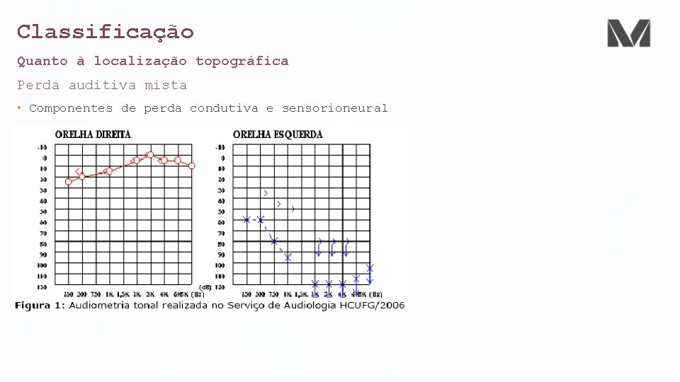 Classificação Quanto à localização topográfica Perda auditiva mista • Componentes de perda condutiva e