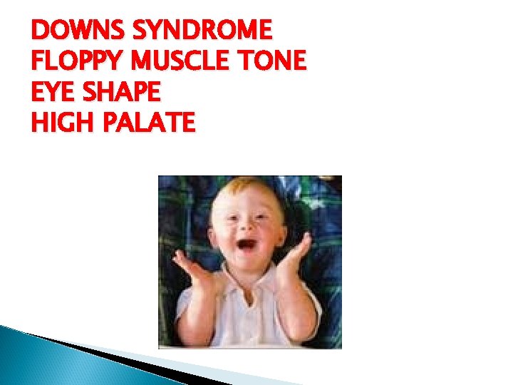 DOWNS SYNDROME FLOPPY MUSCLE TONE EYE SHAPE HIGH PALATE 