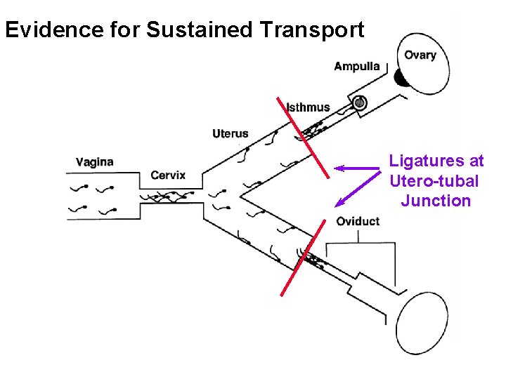 Evidence for Sustained Transport Ligatures at Utero-tubal Junction 