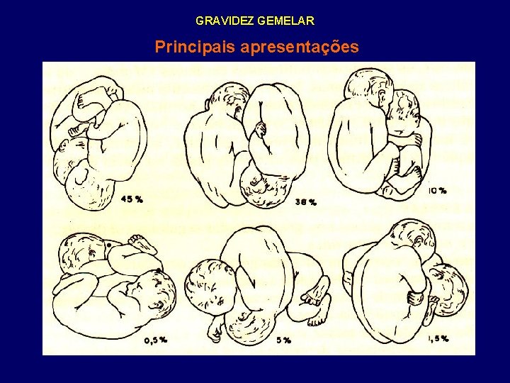 GRAVIDEZ GEMELAR Principais apresentações 