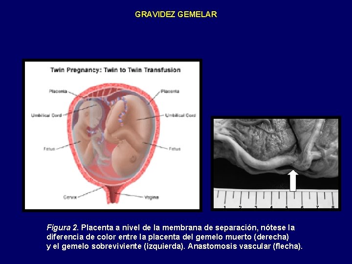GRAVIDEZ GEMELAR Figura 2. Placenta a nivel de la membrana de separación, nótese la