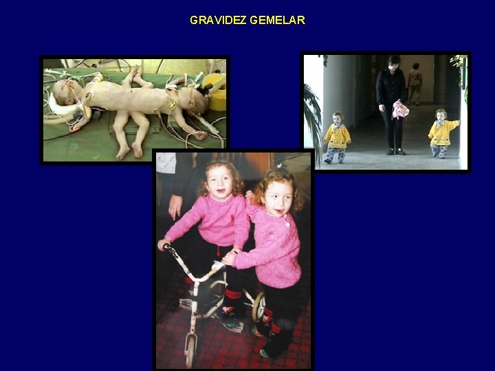 GRAVIDEZ GEMELAR 