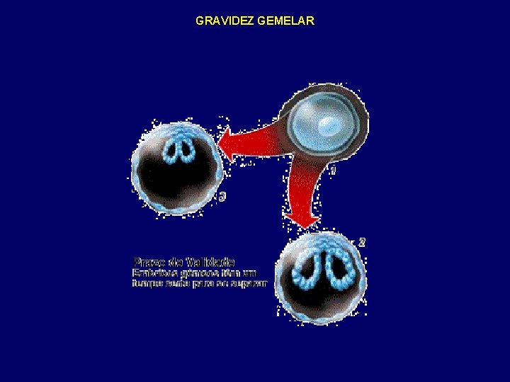 GRAVIDEZ GEMELAR 