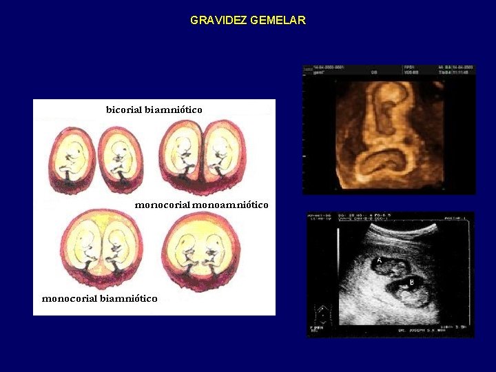GRAVIDEZ GEMELAR 