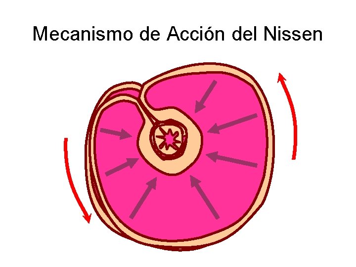 Mecanismo de Acción del Nissen 