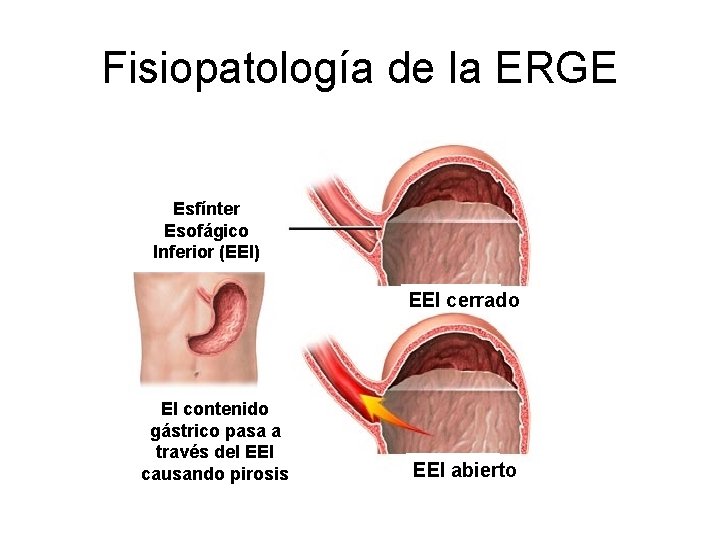 Fisiopatología de la ERGE Esfínter Esofágico Inferior (EEI) EEI cerrado El contenido gástrico pasa