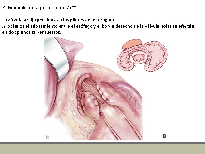 B. Funduplicatura posterior de 270°. La válvula se fija por detrás a los pilares