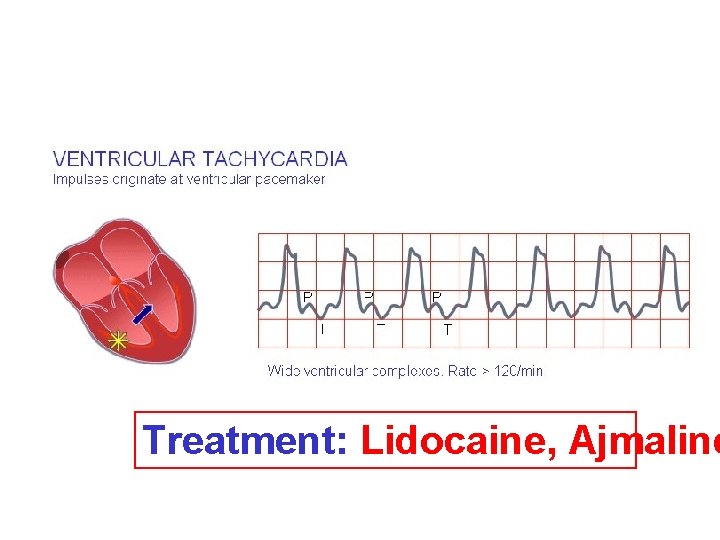 Treatment: Lidocaine, Ajmaline 