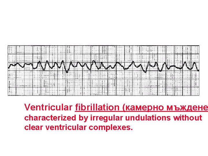 Ventricular fibrillation (камерно мъждене characterized by irregular undulations without clear ventricular complexes. 