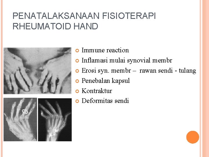 PENATALAKSANAAN FISIOTERAPI RHEUMATOID HAND Immune reaction Inflamasi mulai synovial membr Erosi syn. membr –