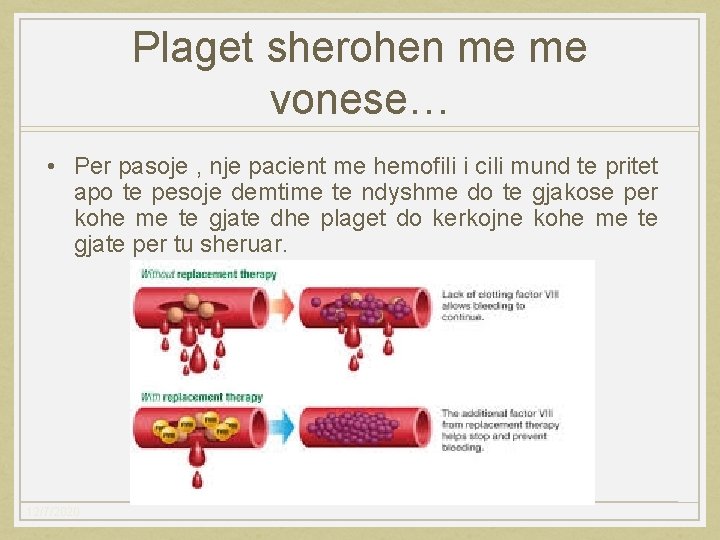 Plaget sherohen me me vonese… • Per pasoje , nje pacient me hemofili i