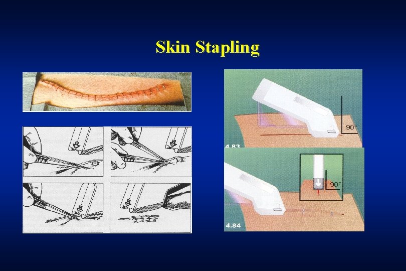 Skin Stapling 