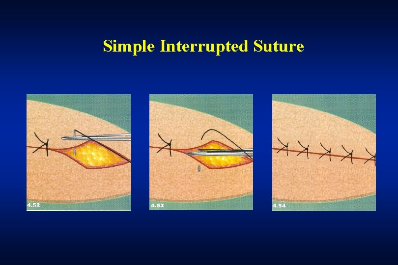 Simple Interrupted Suture 