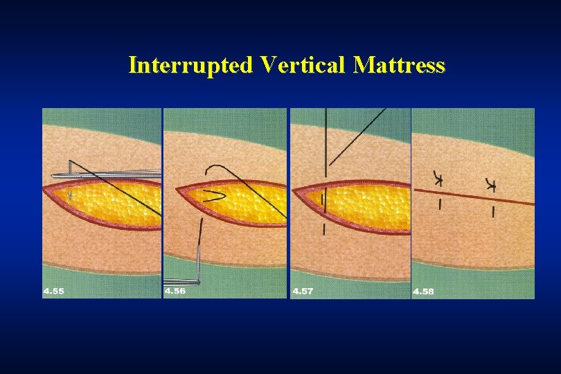 Interrupted Vertical Mattress 