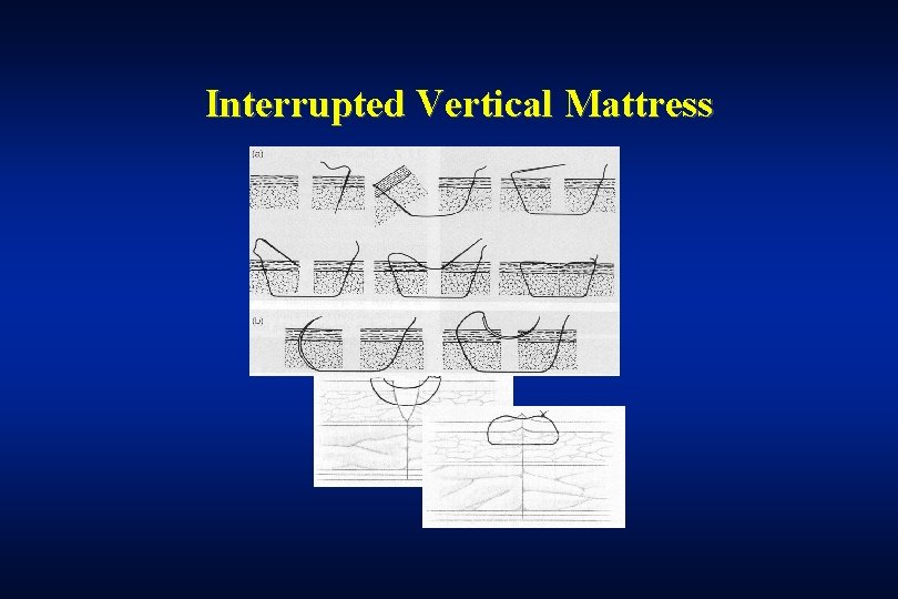 Interrupted Vertical Mattress 