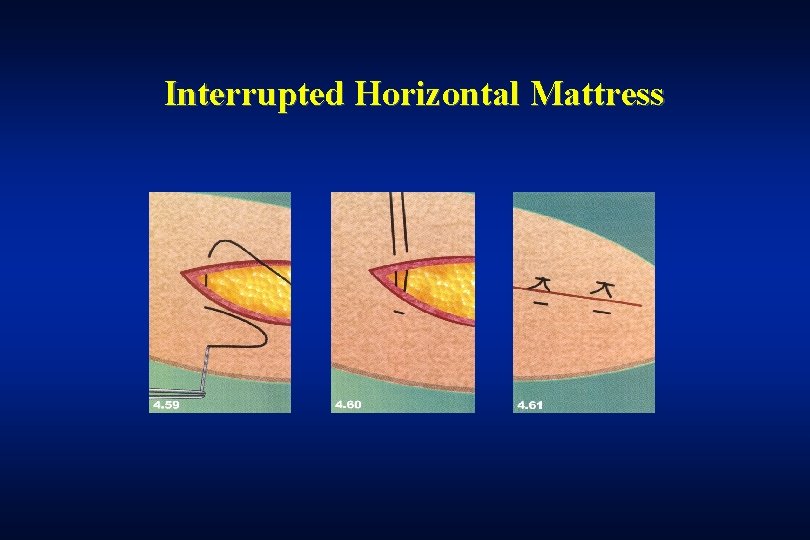 Interrupted Horizontal Mattress 
