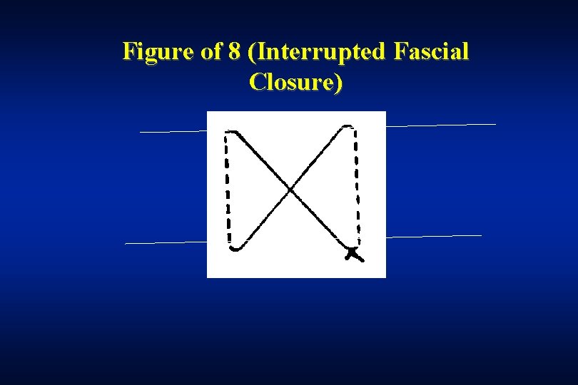 Figure of 8 (Interrupted Fascial Closure) 