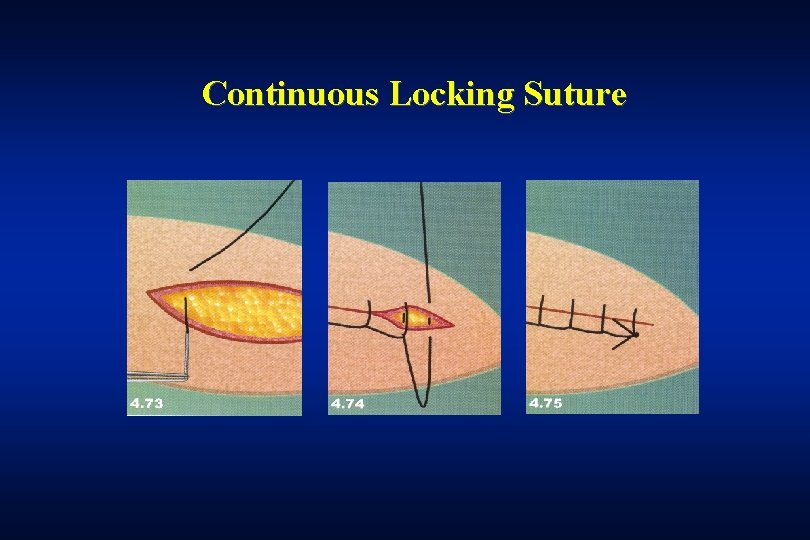 Continuous Locking Suture 