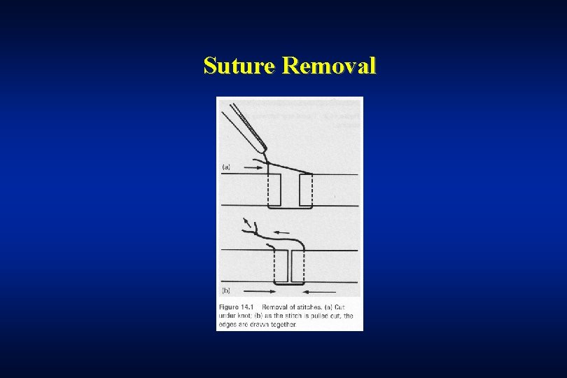 Suture Removal 