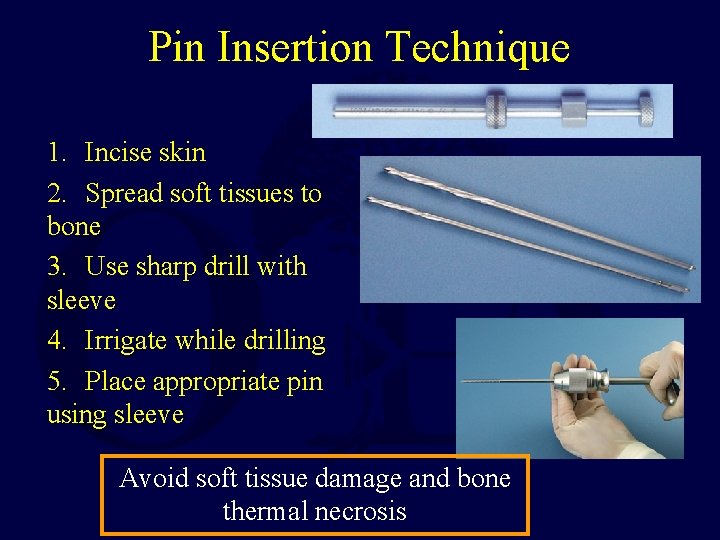 Pin Insertion Technique 1. Incise skin 2. Spread soft tissues to bone 3. Use