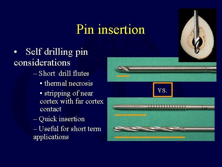 Pin insertion • Self drilling pin considerations – Short drill flutes • thermal necrosis Pin insertion • Self drilling pin considerations – Short drill flutes • thermal necrosis
