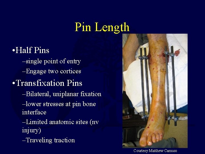 Pin Length • Half Pins –single point of entry –Engage two cortices • Transfixation