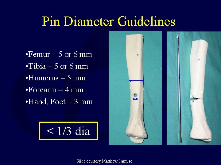 Pin Diameter Guidelines • Femur – 5 or 6 mm • Tibia – 5 Pin Diameter Guidelines • Femur – 5 or 6 mm • Tibia – 5