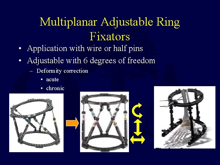 Multiplanar Adjustable Ring Fixators • Application with wire or half pins • Adjustable with Multiplanar Adjustable Ring Fixators • Application with wire or half pins • Adjustable with