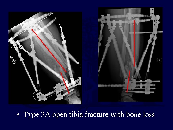 • Type 3 A open tibia fracture with bone loss • Type 3 A open tibia fracture with bone loss