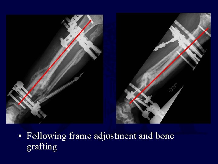 • Following frame adjustment and bone grafting • Following frame adjustment and bone grafting
